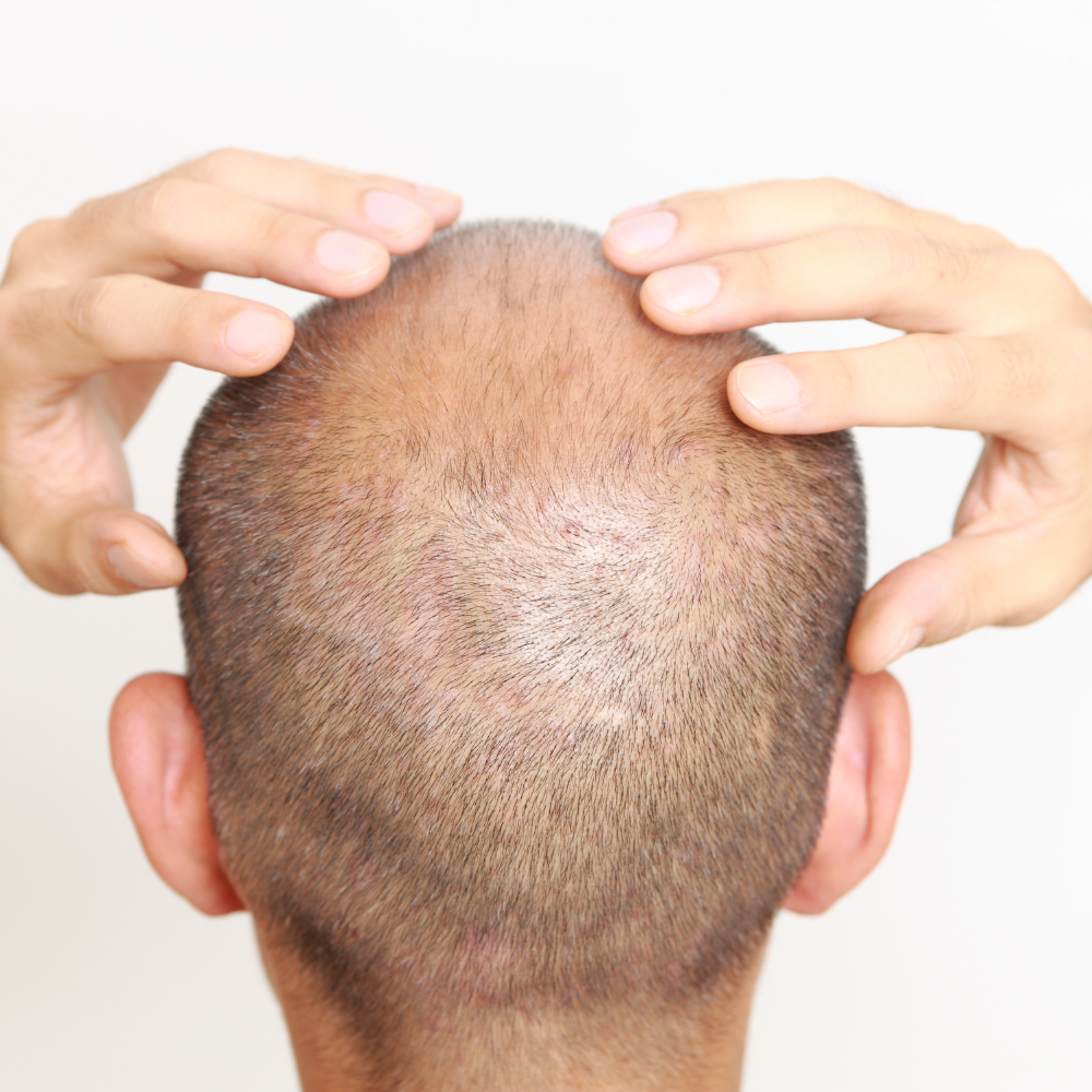 scalp scar repair