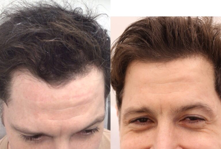 fue hair transplant before