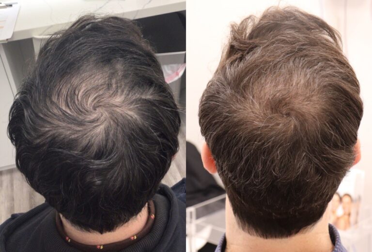 hair transplant before and after