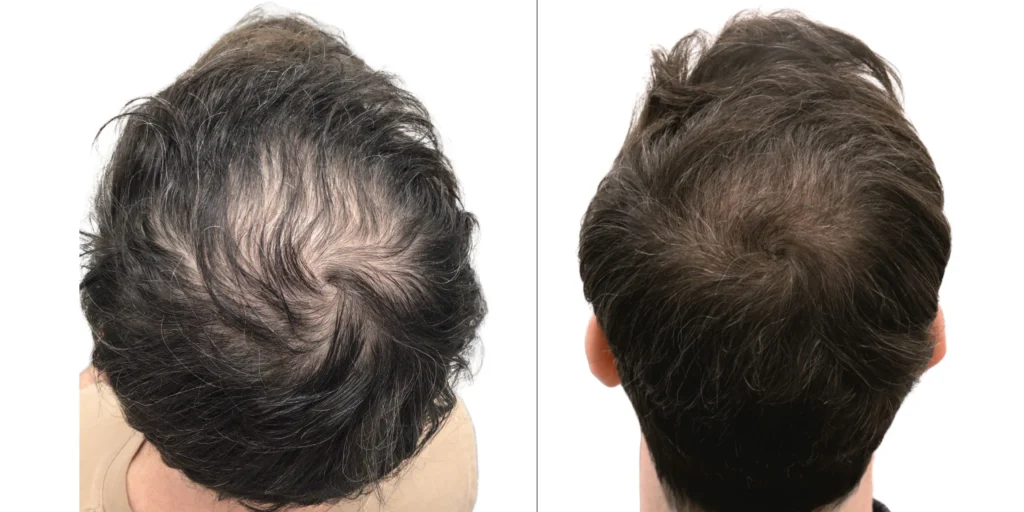 crown hair transplant before and after