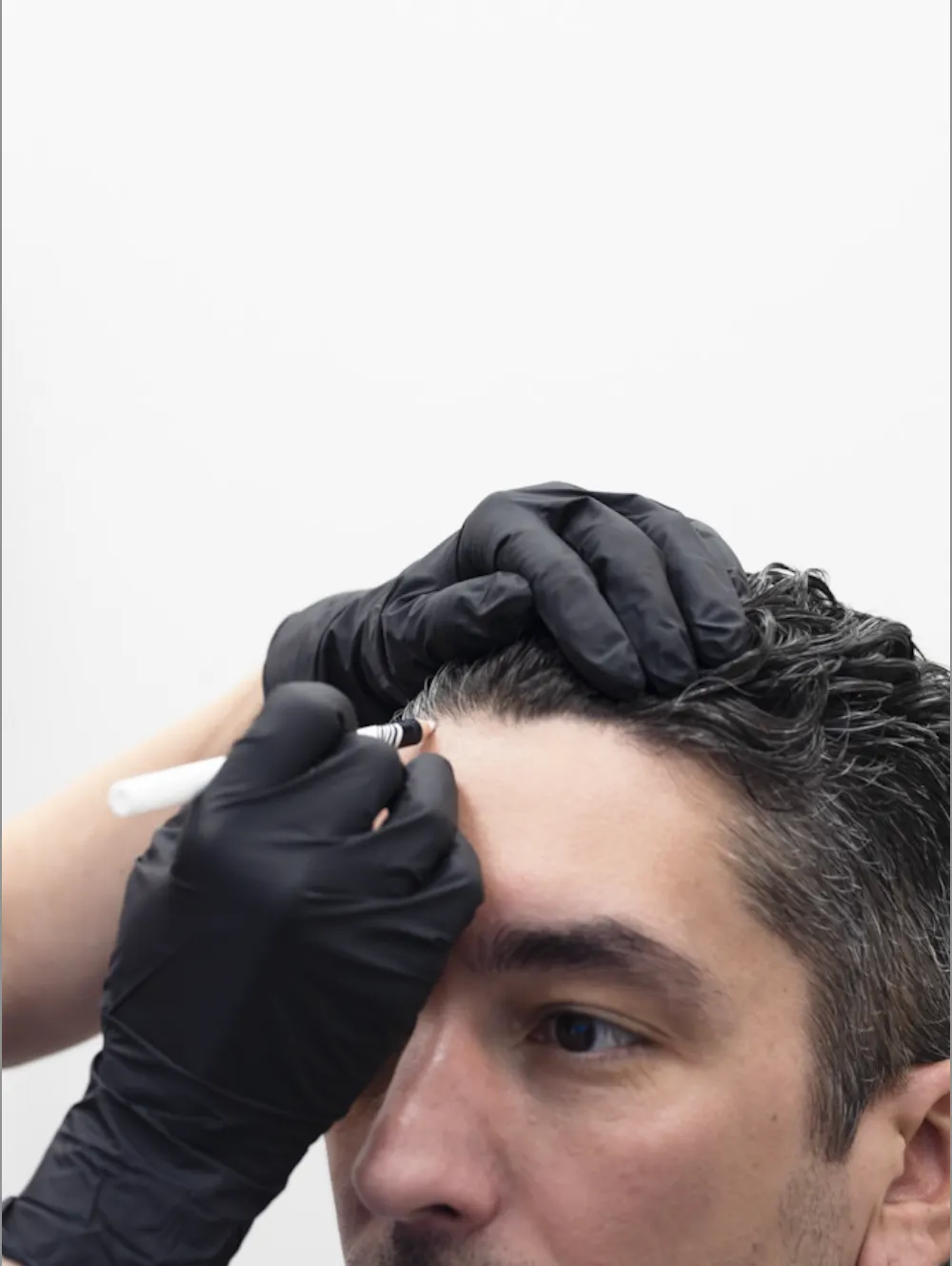 Hair Transplant Toronto