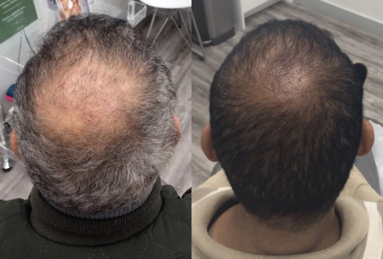 crown hair transplant before and after