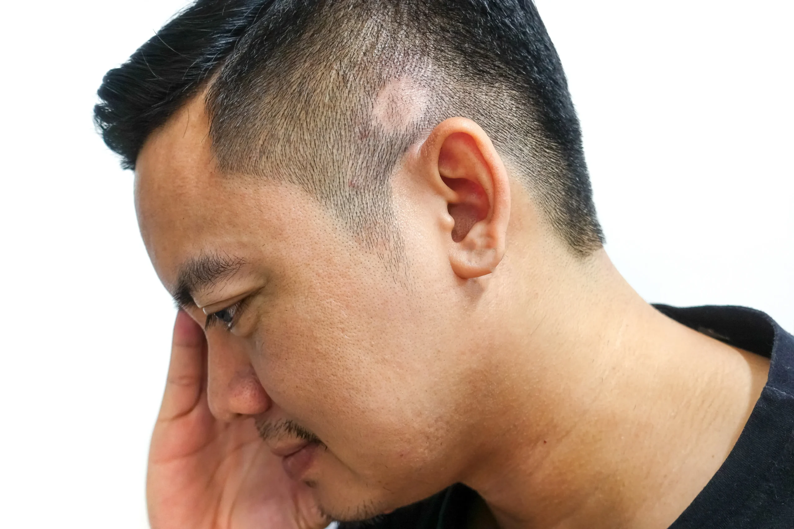 Scalp Scar Treatment