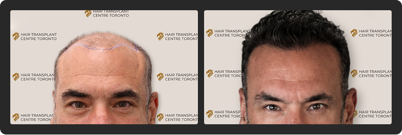 blog 2 - Hair Transplant Centre Toronto Celebrity Hair Transplant Toronto before and after