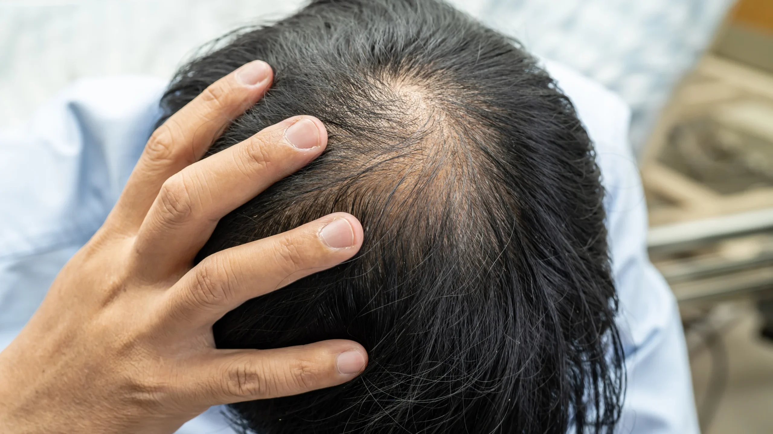 Male Pattern Hair Loss